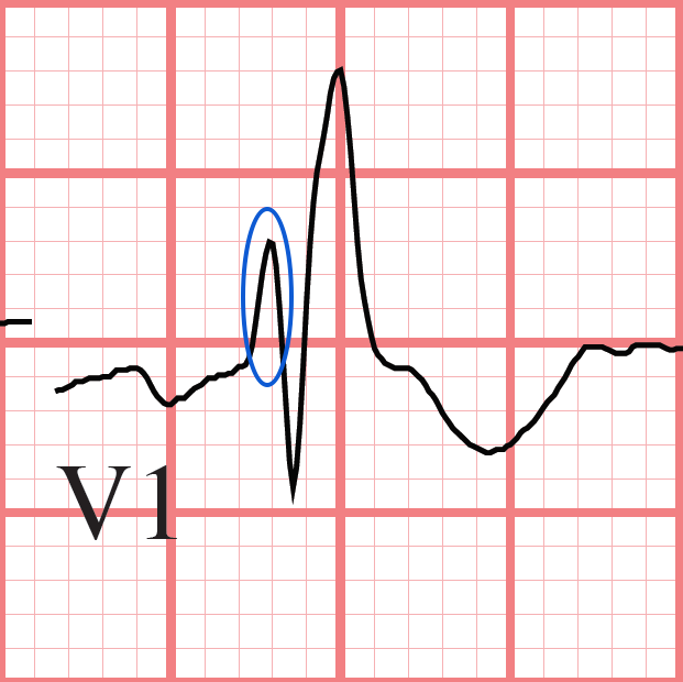 Teaching Medicine - Tutorial: Bundle Branch Blocks